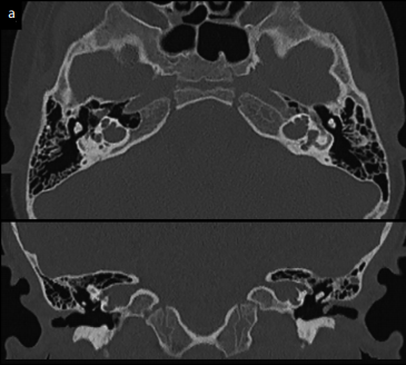 E-ABR in Patients with Cochlear Implant: A Comparison between Patients with Malformed Cochlea and Normal Cochlea