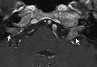 A Case of Gastric Meningeal Carcinomatosis Involving Bilateral Hearing Loss: The Difference between Clinical Images and Autopsy Findings 