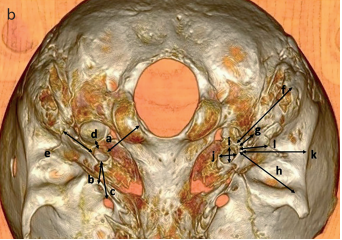 Morphometric Assessment of the Carotid Foramen for Lateral Surgical Approach