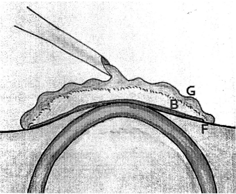 Video Head Impulse Test in Labyrinthine Fistula due to Middle Ear Cholesteatoma