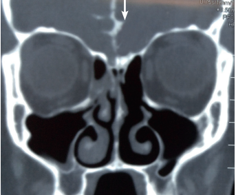 In Patients with Unexplained Non-Epidemic Recurrent Meningitis a Direct Communication between the Subarachnoid Space and the Outside Must Be Sough 