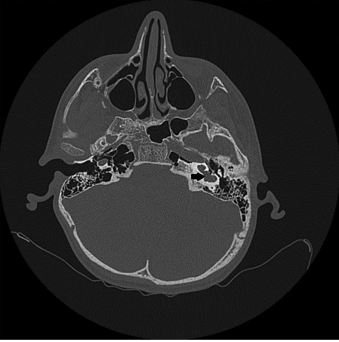 Axial Mesodermal Dysplasia Complex with a Unique Abnormal Course of Vestibulocochlear Nerve