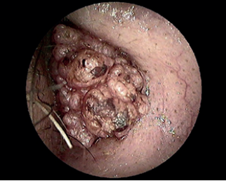 Seborrheic Keratosis or Squamous Carcinoma? Clinical Examination versus Biopsy: The Importance of Criticism