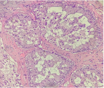 Jugular Foramen Metastasis from Lung Cancer:  A Case of “A Mass without His Syndrome”