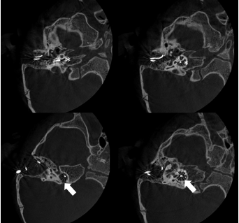 Extra-Cochlear Insertion in Cochlear Implantation:  A Potentially Disastrous Condition