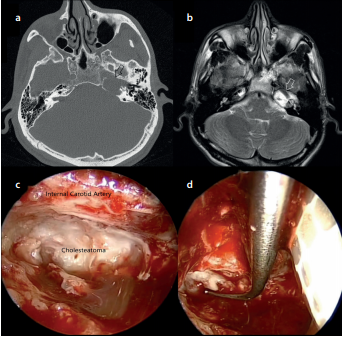 Endoscope-Assisted Surgery for Petrous Bone Cholesteatoma with Hearing Preservation
