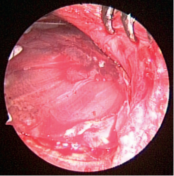 Prevention of Craniofacial Pain Secondary to Harvesting of Temporalis Fascia - A Novel Technique