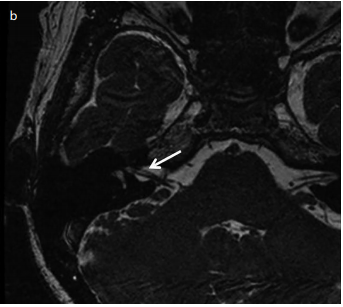 The Long-Term Efficacy of Cochlear Implantation for Hearing Loss in Muckel-Wells Syndrome