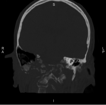 Extensive Skull Base Osteomyelitis Secondary to Malignant Otitis Externa