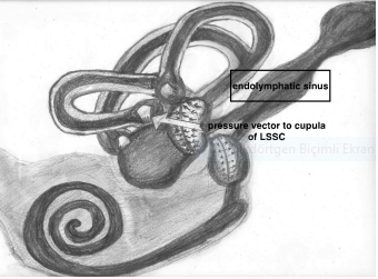 The Role of Mobile Phone Camera Recordings in the Diagnosis of Meniere’s Disease and Pathophysiological Implications