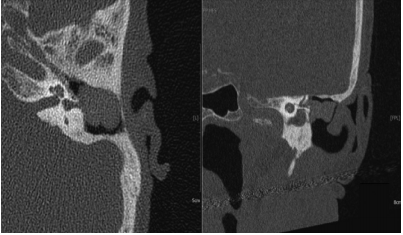 Inner-Ear Disorders Presenting with Air–Bone Gaps: A Review